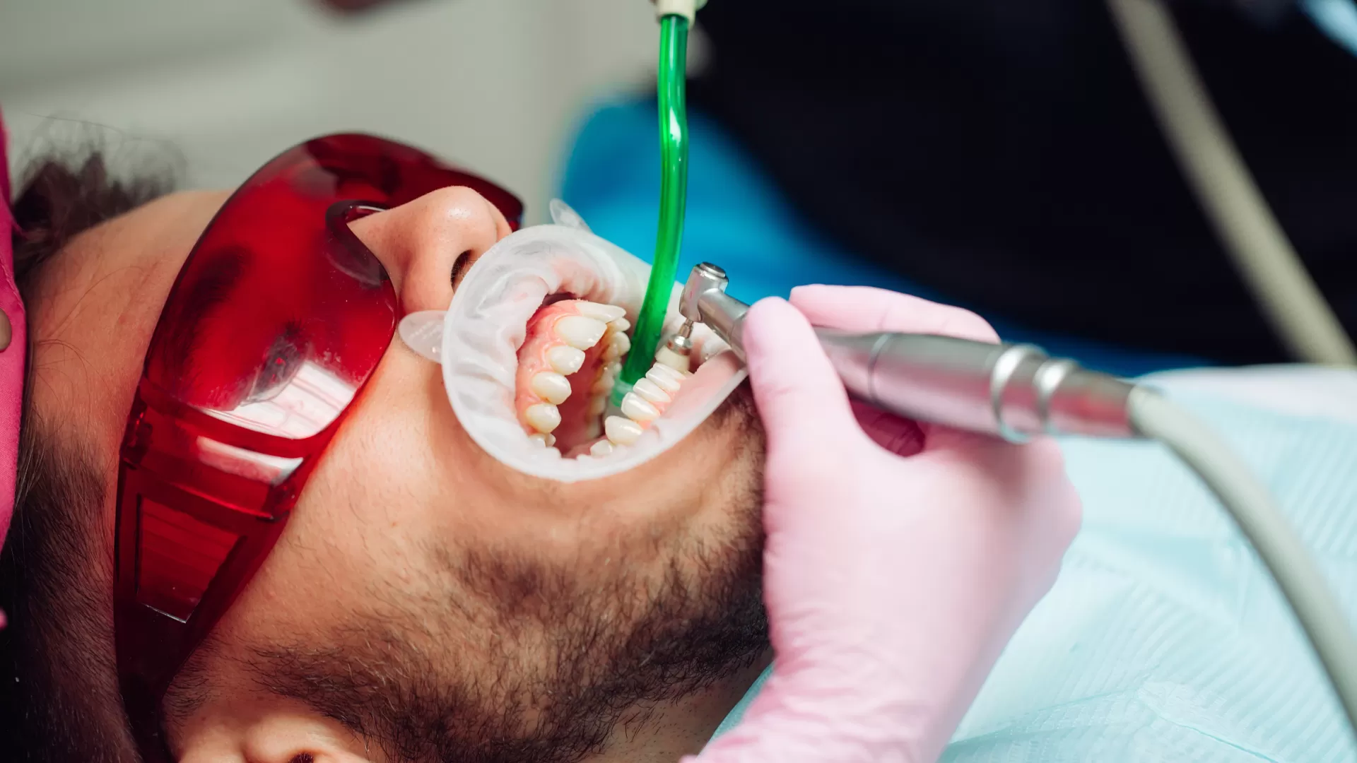 ¿Qué es una limpieza dental profesional?
