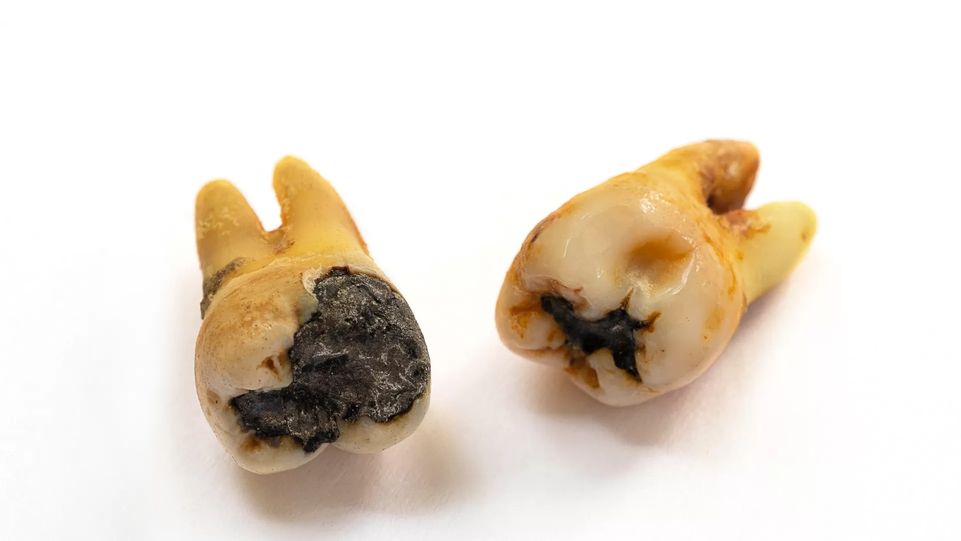 Mitos y verdades sobre las caries